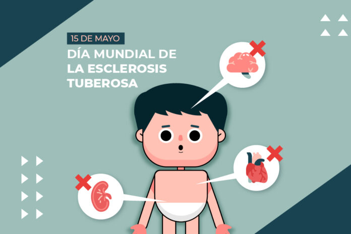 Esclerosis Tuberosa salud niños