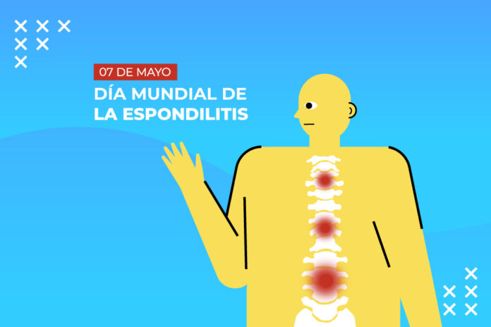 que es la espondilitis